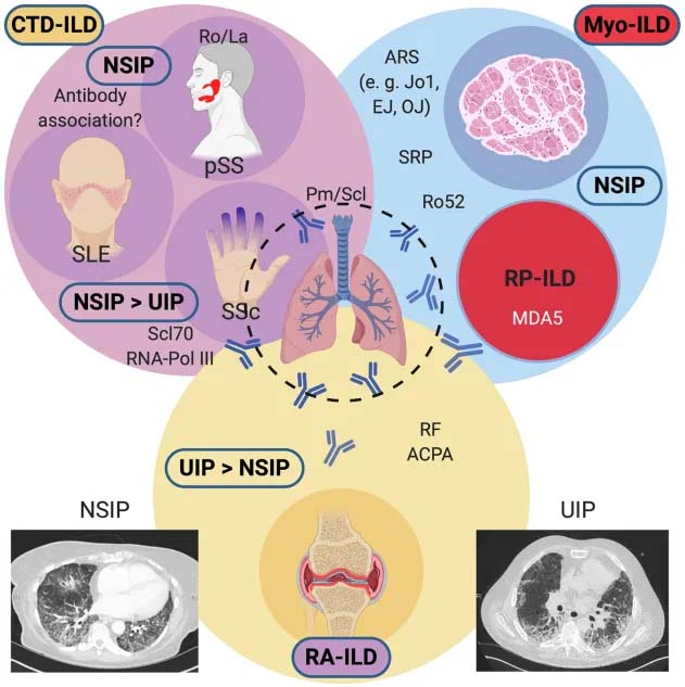 CTD-ILD-img