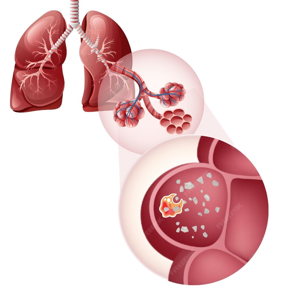 Silicosis-img