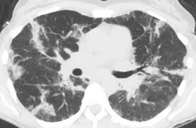 Eosinophilic lung diseases