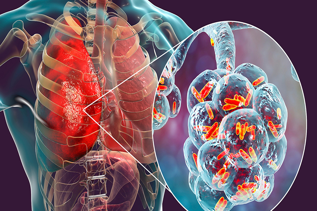 Tuberculosis